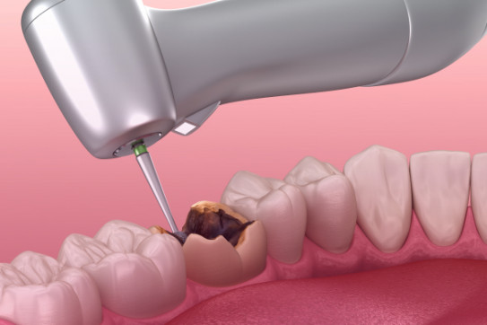 Лечение кариеса и пульпита