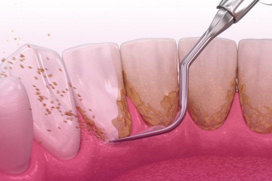 Удаление зубного налета, камня