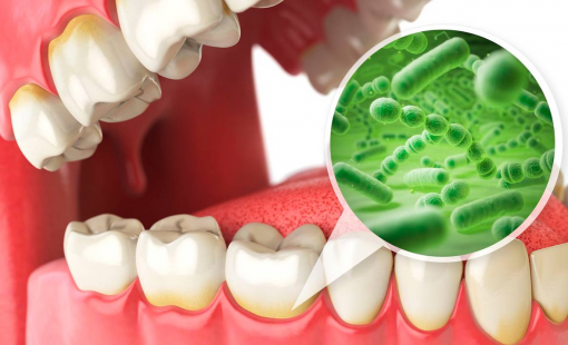 Зубной налет: причины, симптомы и лечение.