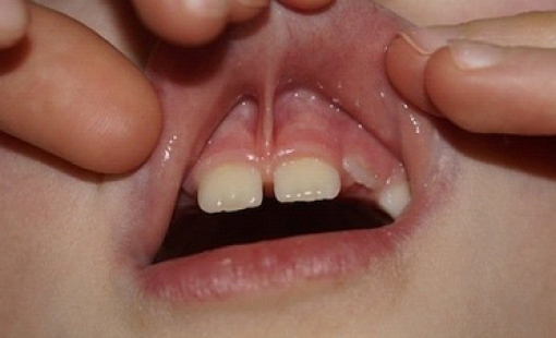 Пластика уздечки верхней губы