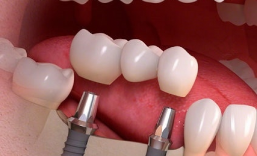 Что такое зубной имплант?